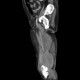 Sarcoma of thigh: CT - Computed tomography